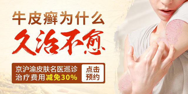 阜阳治疗银屑病医院