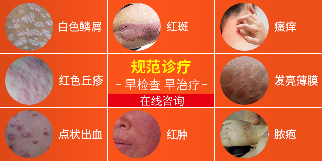 阜阳银屑病医院